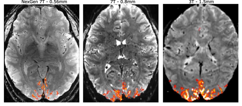 MRI-Makine-1024x450 Beyin MR Görüntüleme Teknolojisinde Yeni Çağ : NexGen 7T MRI