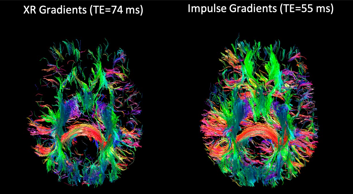 NexGen-7T-Brain-Scanner-Allows-for-Detailed-Tractography Beyin MR Görüntüleme Teknolojisinde Yeni Çağ : NexGen 7T MRI